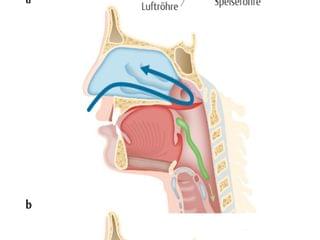 Legen einer Nasogastralen Sonde