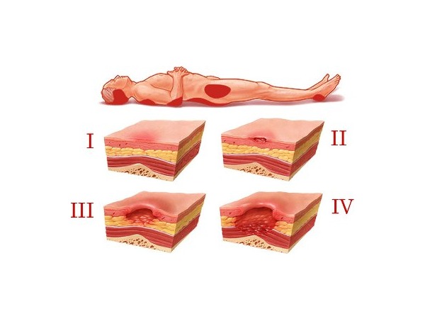 Dekubitus Am Gesäß Wie Behandeln Dekubitusprophylaxe