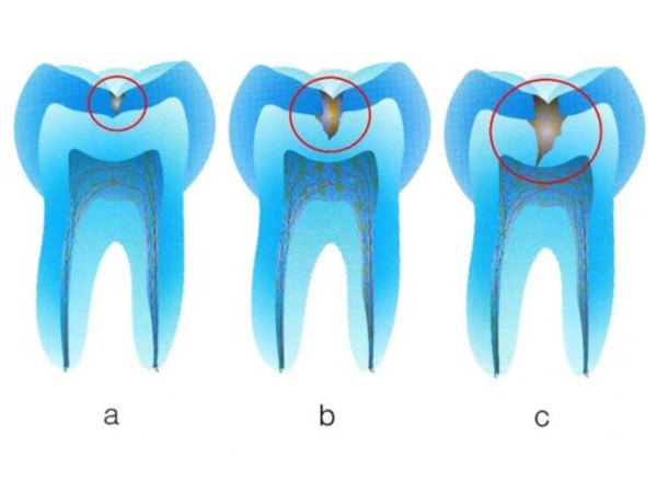 Endo1